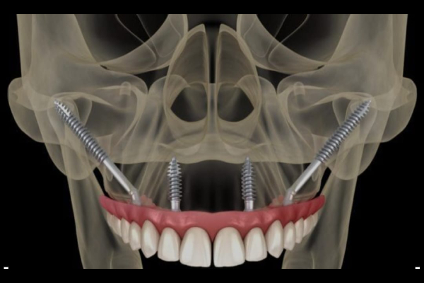 Subperiosteal Implant