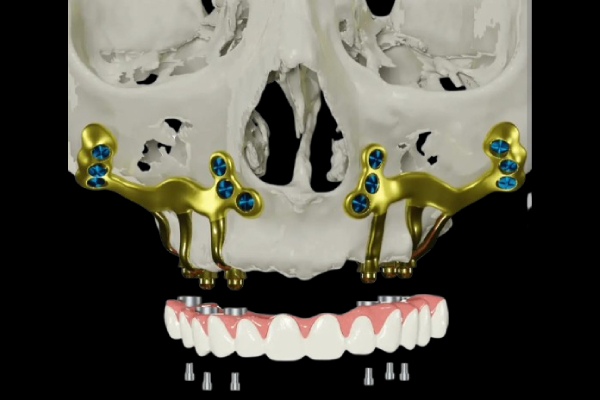 Zygomatic Implant